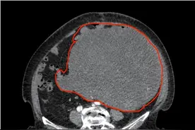 太婆腹腔藏13斤重巨大肿瘤，医生6小时手术成功“排雷”图片