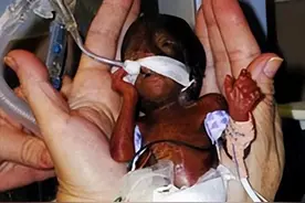 2006年，美国出现真实版拇指姑娘，出生时仅24厘米，如今怎样了？图片