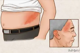 有一种痛叫“带状疱疹”，和水痘有什么区别？又该如何预防？图片