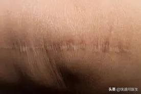 剖腹产后，做好这几点或能避免瘢痕增生图片