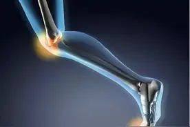 氨糖，是挽救关节的良药，还是一无是处的安慰剂？医生给出真相图片