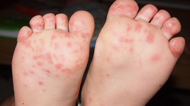 小儿皮疹图片和症状及治疗 小儿皮疹症状图片