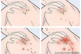 红疙瘩一直不消，奇痒图片