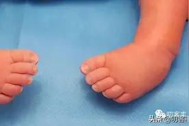 新生儿常见的足部畸形图片