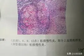 宫颈活检有疣样改变是什么意思图片