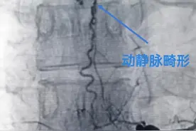 内蒙古完成一例罕见脊髓动静脉畸形切除手术图片