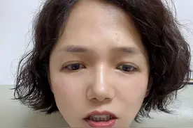 祛斑技术后反黑咋办？#关注我每天坚持分享知识图片