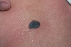 一块胎记，让4岁女孩“性早熟”！这1种癌变胎记，越早治疗越好图片