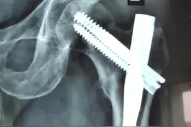 骨折了，为什么明明保守治疗骨头也能长好，医生却建议手术？图片