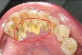 满嘴牙结石怎么在家自己清除？刷牙时加点它，成片牙石自行脱落！图片