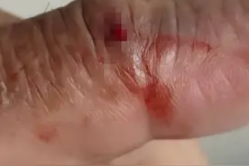 村民干活时被“寡妇蛇”咬伤，生命垂危！关键时刻，幸好有他们图片