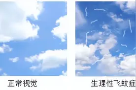 眼前总是有“黑色小虫子在飞、小黑影、浮游物”是得白内障了吗？图片