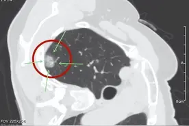磨玻璃肺癌，最佳干预的时机是哪个阶段：AAH、AIS,抑或MIA？图片