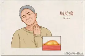 脂肪瘤必须要手术治疗吗，中药疗效好、痛苦少、并且不易复发图片