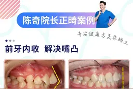 12岁上颌前凸+牙齿拥挤，16个月就完成矫正了图片
