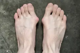 天津38岁程女士，从小长了双“男人脚”，公开拇外翻微创经历图片