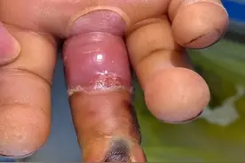 『倒刺』，到底撕不撕？图片