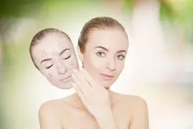 脸上痘印怎么去掉？教你几招彻底去除！有痘印的有福了图片