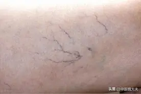 再次提醒：腿上有这种“红血丝”的人，可能是身体发出的危险信号图片