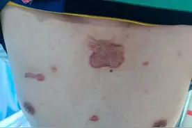 胸口长痘被手挤成“肉疙瘩”，医生“借皮补位”为小伙除疤图片