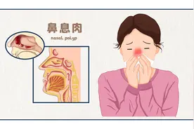 鼻息肉个头虽小麻烦大，但有了这些预防、治疗方法不用怕图片