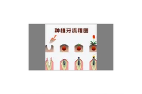 种植牙能用多久？能否做到这6点，决定种植牙的寿命图片