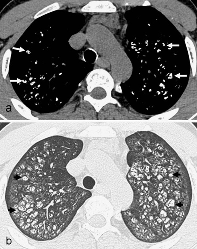 CT 检查中高密度肺部异常表现