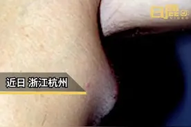 男孩撸猫后发烧12天腋下长鸡蛋大肿块图片