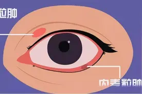 眼睛长“针眼”，是因为看了羞羞的东西？这答案我也是没想到图片