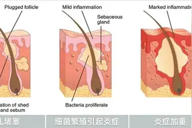 头皮、前胸后背总长痘？收好这份战「痘」指南，4招轻松解决图片