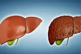 肝硬化5大恶化前兆，很容易被“误诊”！预防肝硬化，需要这样做图片