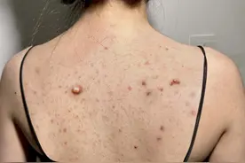 后背长痘还溃脓？还真不是皮肤病，学会这几招痘痘洗洗就没！图片