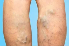 「科普」静脉曲张如何缓解？静脉曲张袜到底有没有用？图片