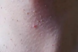 脖子和腋下的“小肉粒”是什么？可以直接用手揪掉吗？图片