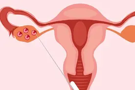 关于取卵你要知道的7件事，关系试管成功图片