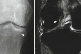 前交叉韧带撕裂间接征像图片