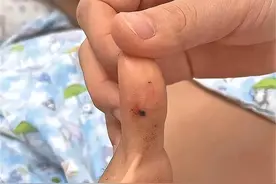 ​20岁女孩被“本地蛇”咬伤，注射血清后病危，医生：她在说谎图片