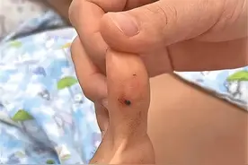 ​20岁女孩被“本地蛇”咬伤，注射血清后病危，医生：她在说谎图片
