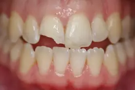 牙齿折断不是应该补上去吗，为啥要做根管治疗？图片