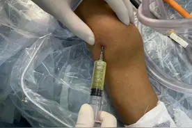 儿童不明原因关节肿胀需当心---“幼年特发性关节炎”图片
