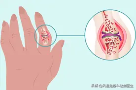 医生盘点9个类风湿关节炎硬知识，拒绝残疾实现停药缓解图片
