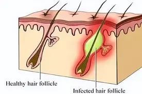 下面长痘痘可咋整？会不会是性病？图片