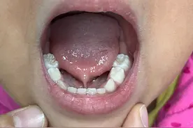 4岁孩子说话“大舌头”，舌系带短该不该手术？图片