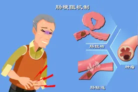 肠梗阻咋回事？拉不出屎背后真相是啥？肠梗阻发病机制动漫版！图片