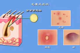 身上长痘痘、小脓疱没事？超短裙谁穿谁尴尬，毛囊炎究竟是个啥？图片