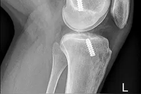 前交叉韧带重建术后康复计划图片