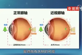近视手术无法治愈近视，近视一旦发生不能治愈或逆转图片