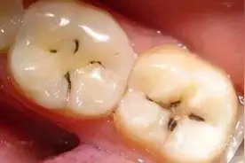 补牙一般多少钱？图片