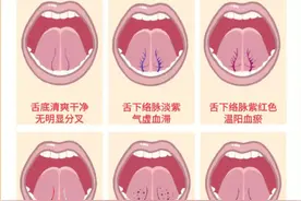6种常见舌底状态图片
