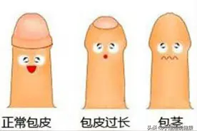 10岁以下的男孩，不一定非要环切，处理包皮的方法很重要图片